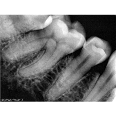 Dental Digital X Ray Sensor with Dental USB