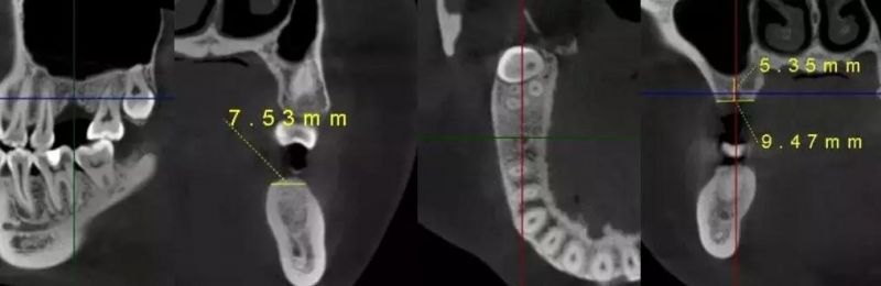 Hires3d-Max The Largest Fov Professional X-ray Dental Cbct Machine