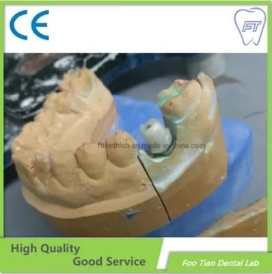 Zirconia Abutment Dental Implant Denture Lab with High Quality