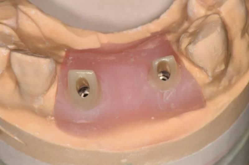 Dental Material Lab Implant Dental Lab Custom Zirconia Implant Abutments Used for Implant Cases