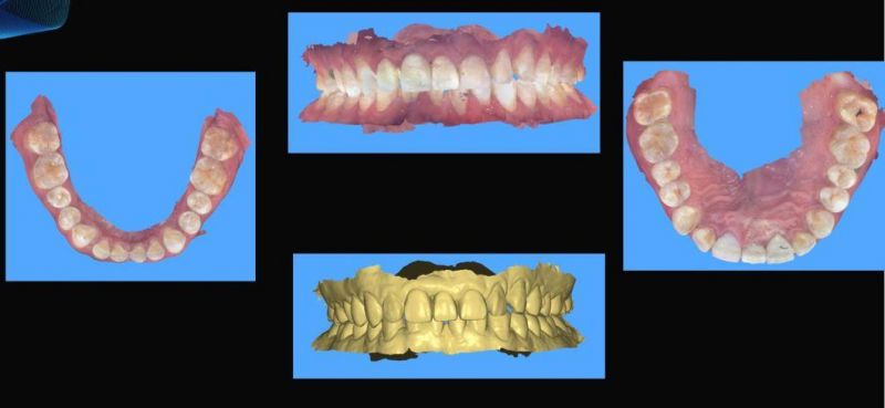 Dental 3D Scanner CAD Cam Ios Intraoral Scanner