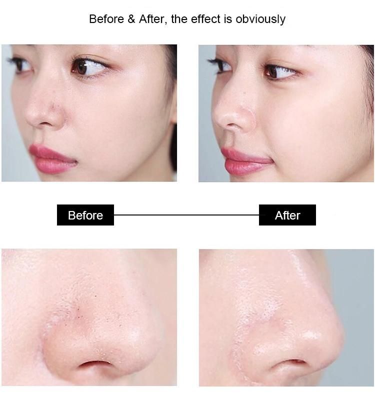 Nose Blackhead Remover Facial Blackhead Remover Face Skin Pore Cleaner