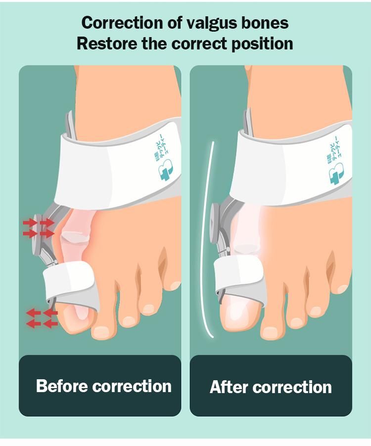 Tech Love High Quality Toe Straightener Splint Corrector Fit Bunion Hallux Valgus